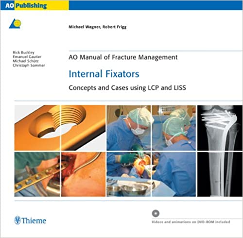 AO Manual of Fracture Management: Internal Fixators: Concepts and Cases using LCP/LISS - Orginal Pdf